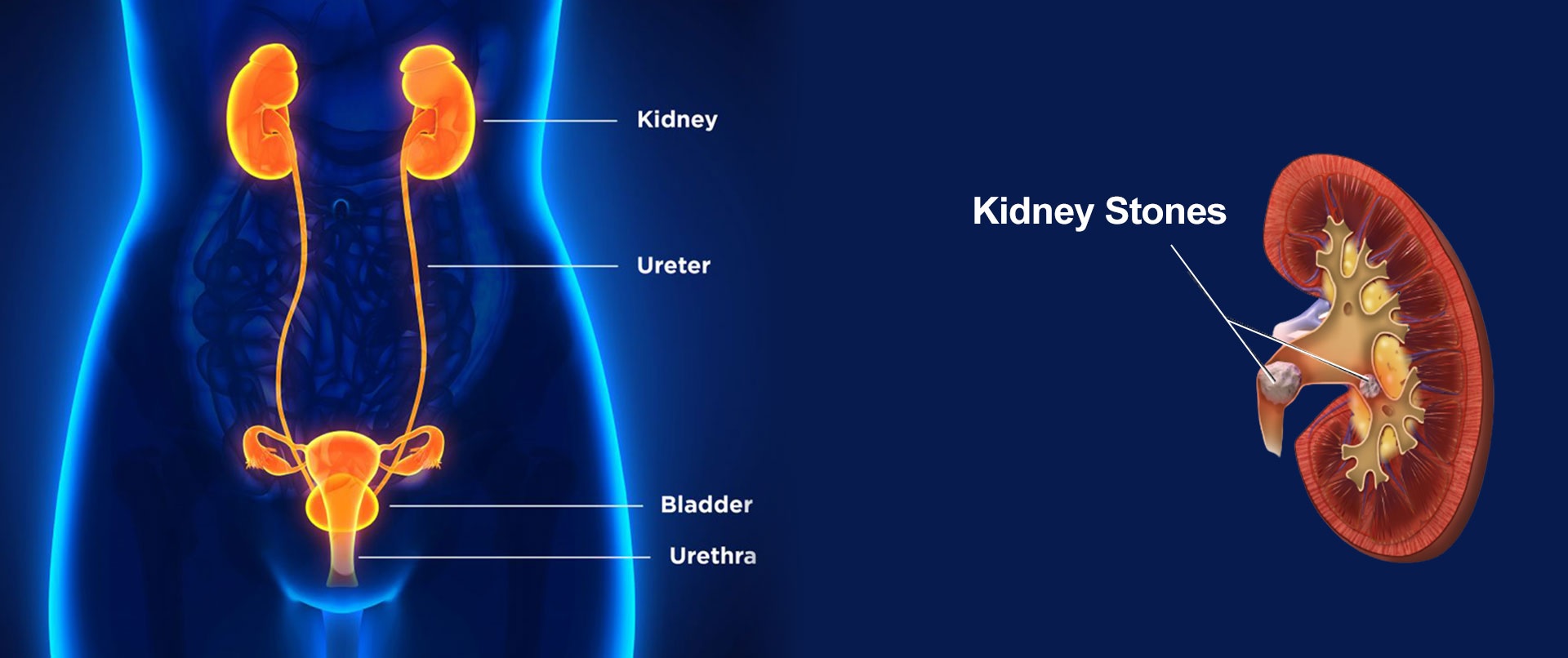 kidney-stone-in-tamil-2023