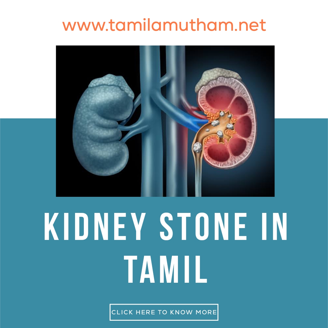 KIDNEY STONE IN TAMIL 2023 